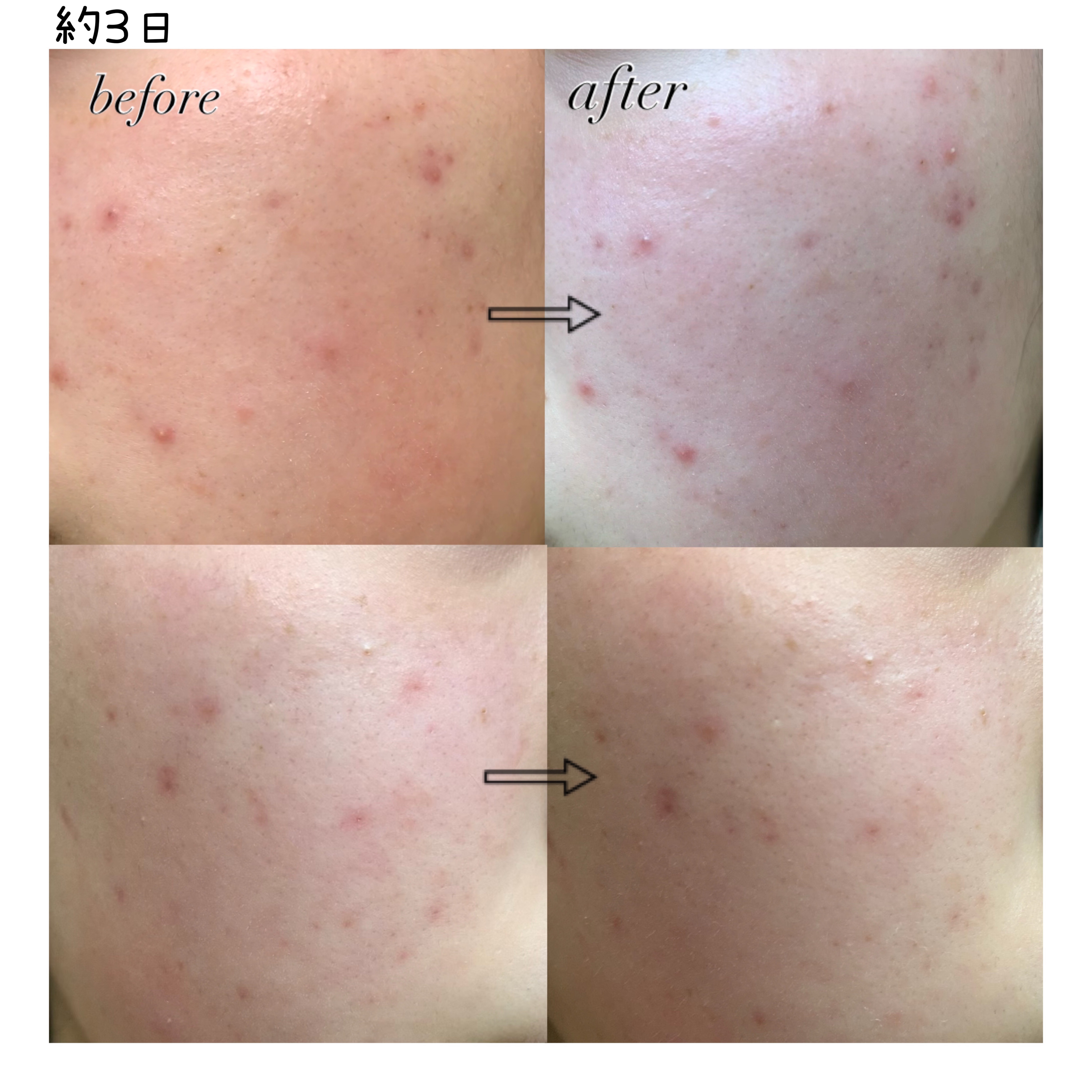 リードルショット100/VT/美容液を使ったクチコミ（2枚目）