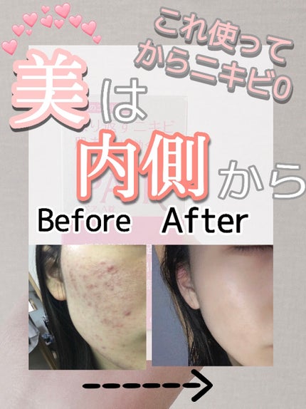 ペアA錠 (医薬品)/ペア/その他を使ったクチコミ(1枚目)