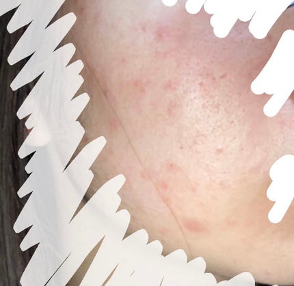 オードムーゲ 薬用ローション(ふきとり化粧水)/オードムーゲ/拭き取り化粧水を使ったクチコミ(3枚目)