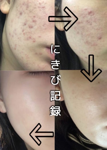 22年最新 高校生 ニキビ跡特集 口コミで人気のおすすめ44アイテムを紹介 Lips 22年最新 高校生 ニキビ跡特集 口コミで人気のおすすめ44アイテムを紹介 Lips