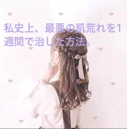 ペアアクネクリームW(医薬品)/ペア/その他を使ったクチコミ(1枚目)