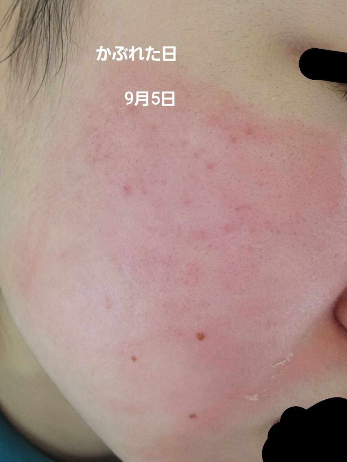 supreme_beauty_i9e4 on LIPS 「べピオゲルやめて5日目!(忙しくて毎日投稿は出来ませんでしたす..」(2枚目)