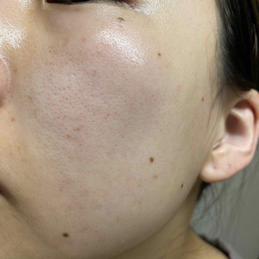 fresh_lips_rmq on LIPS 「5/18ぽちぽちできては消える..」(2枚目)