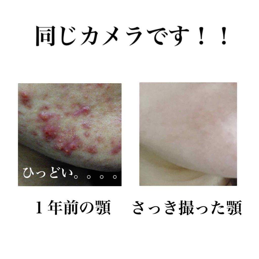 ニキビ治療薬クリーム (医薬品)/クレアラシル/その他を使ったクチコミ(4枚目)