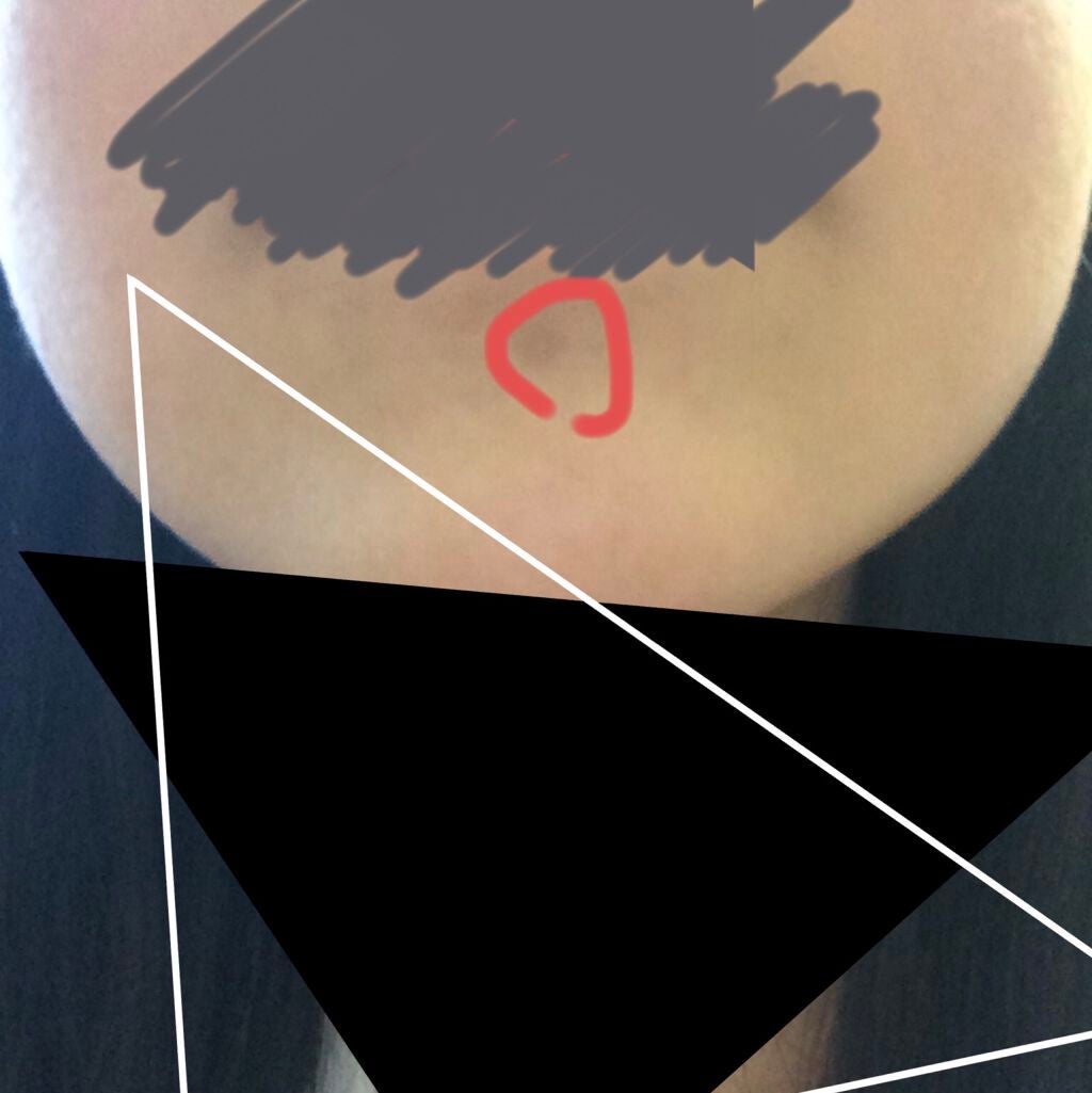 オロナインH軟膏 (医薬品)/オロナイン/その他を使ったクチコミ(3枚目)