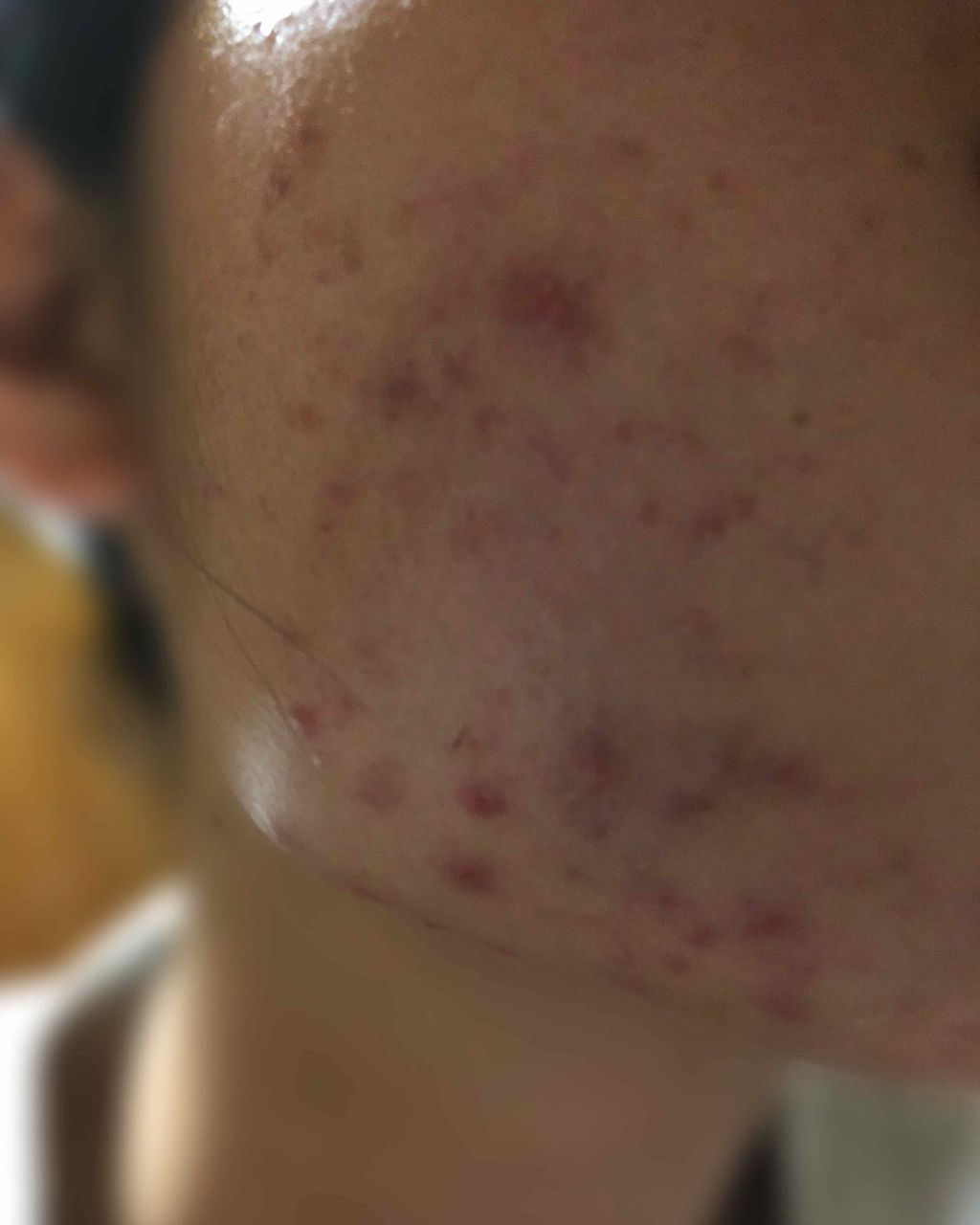 くもくも on LIPS 「自分のメモ用に使いながら何かアドバイスあれば下さいニキビ酷いの..」(2枚目)