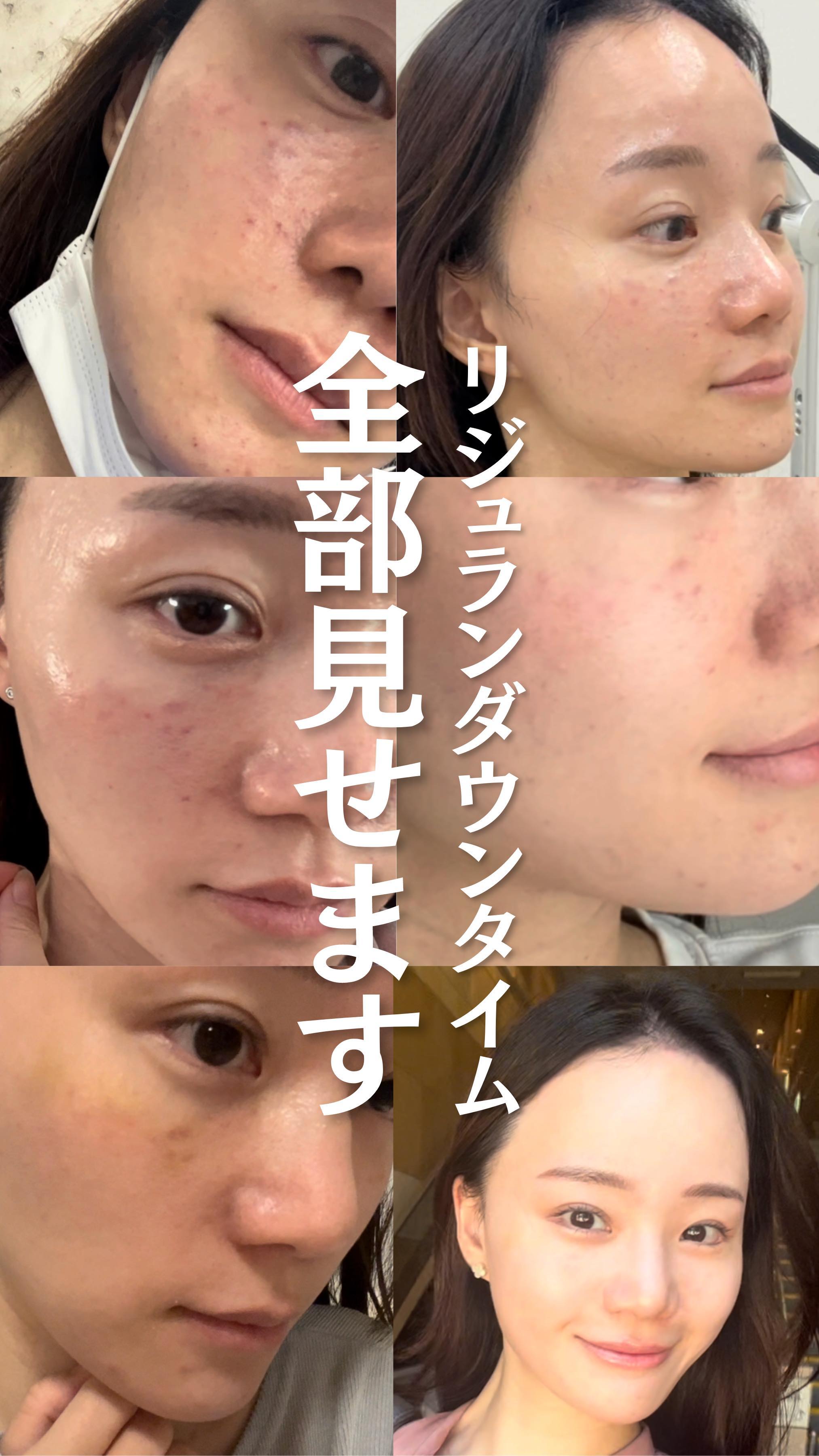 韓国でやってきたリジュランのダウンタイムを、無加工ノーマルカメラ撮影で全部見せます！🇰🇷（1週間）
検討されている方の参考になりますように✨

　
　
#韓国旅行 #韓国美容 #韓国美容皮膚科 #韓国情報 #リジュラン #美容医療 #綺