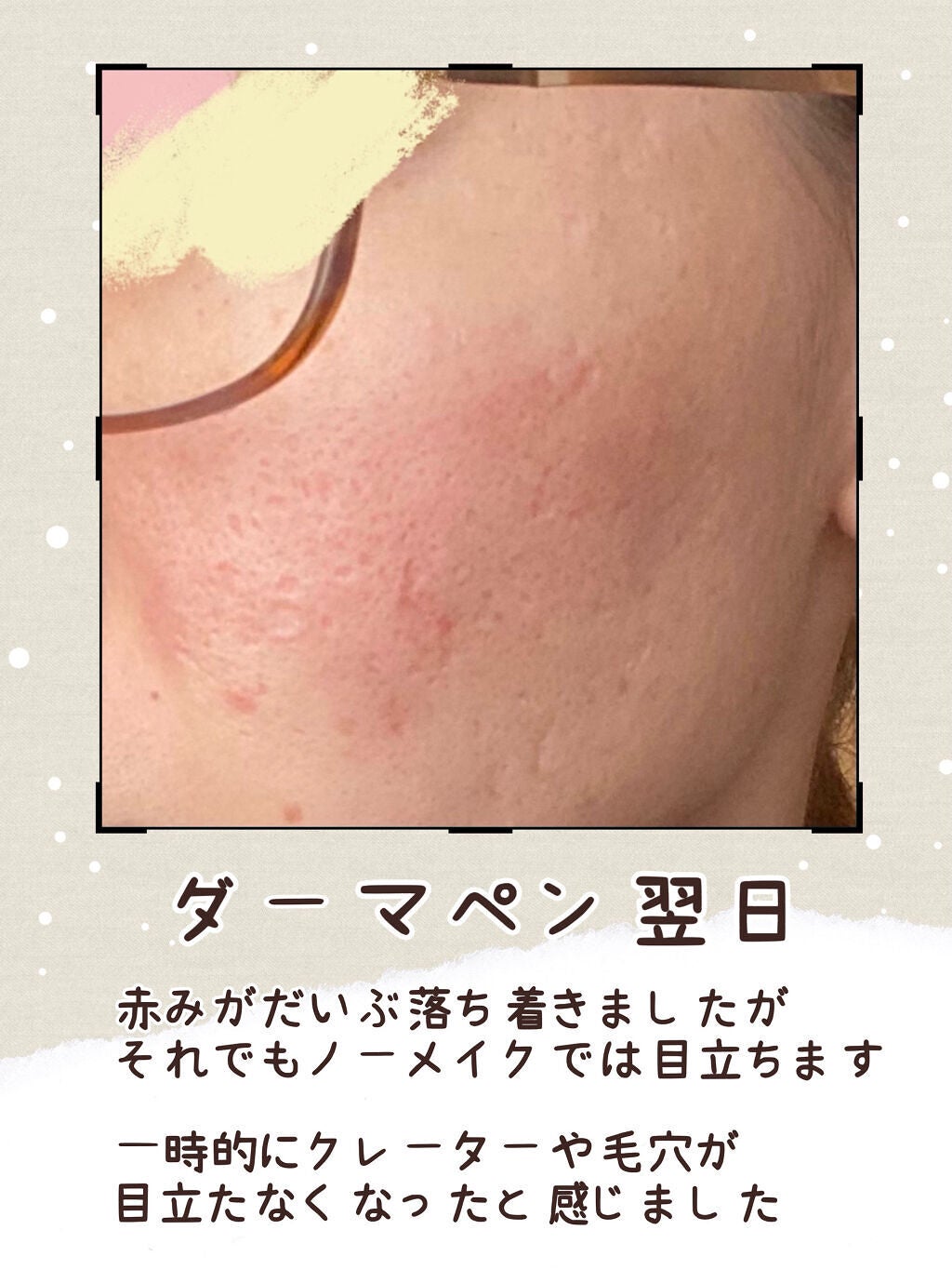 V on LIPS 「クレーター肌のダーマペン4備忘録📝中学生の時に顔一面のニキビに..」(4枚目)