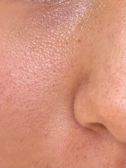 ゴムポン 小鼻つるつる/コパ・コーポレーション/その他スキンケアグッズを使ったクチコミ(2枚目)