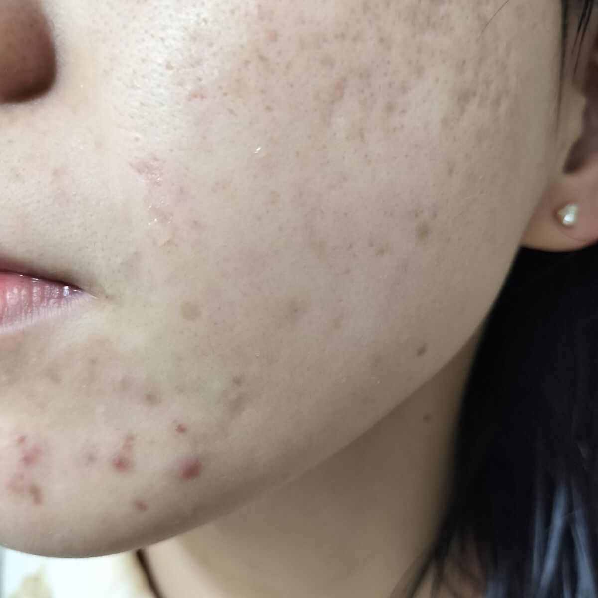 テラ・コートリル 軟膏(医薬品)/ジョンソン・エンド・ジョンソン/その他を使ったクチコミ（2枚目）