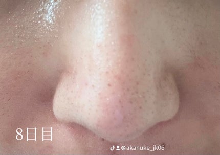 ðââïžð«° on LIPS ãã€ãœãã¬ããã€ã³ã®çµéðãã£ãšããã¯ããŠããã§ããã©ã1æ¥ãµã..ãïŒ7æç®ïŒ