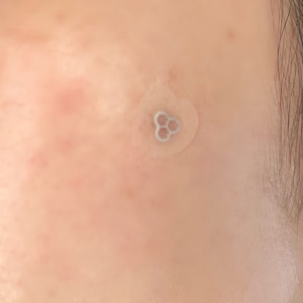 ACマグネシウムパッチ ミニ/スノーツープラス/にきびパッチを使ったクチコミ(4枚目)