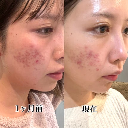 ニキビあとケアジェル/アットノン/その他スキンケアを使ったクチコミ(2枚目)