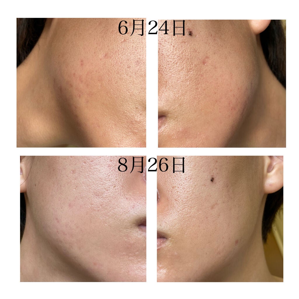 N10+Z1フェイスセラム /The Ordinary/美容液を使ったクチコミ(8枚目)