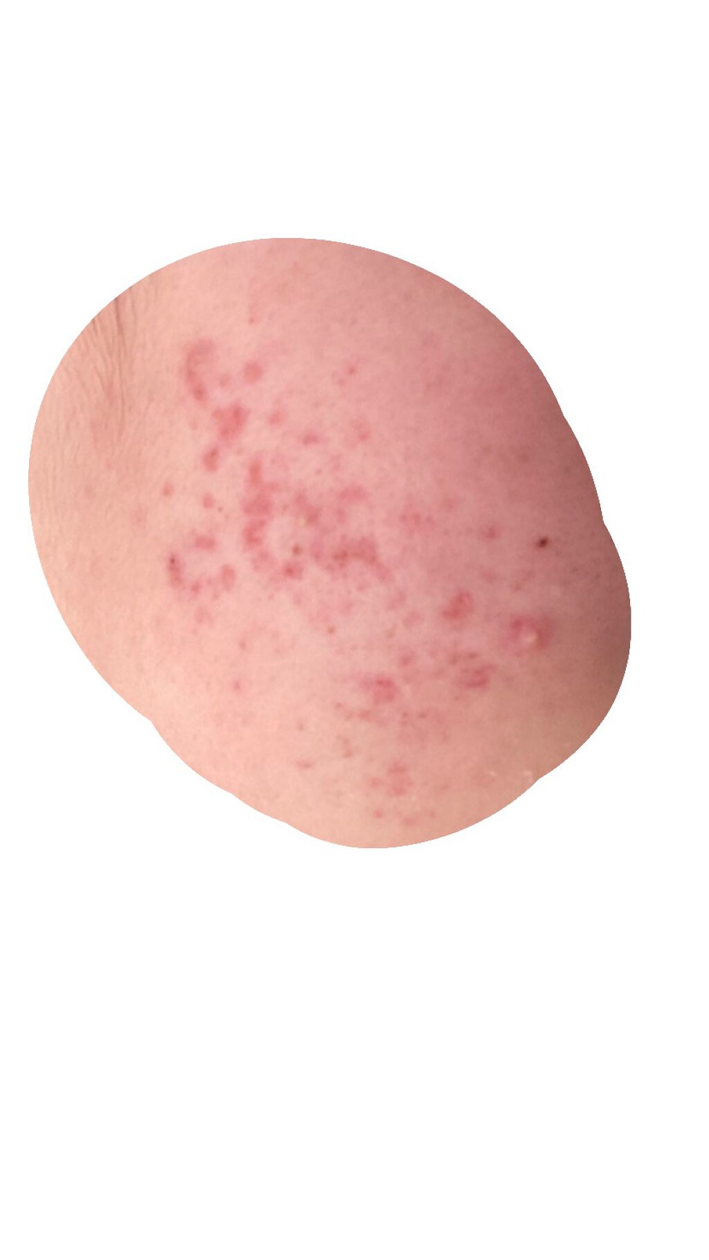 ベピオゲル/マルホ株式会社/その他を使ったクチコミ（1枚目）