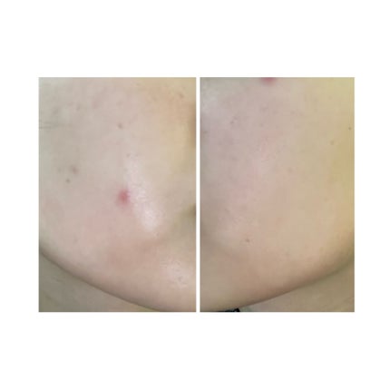 ぽむ on LIPS 「2023.9.13皮膚科に受診 エピデュオとヘパリン処方1枚目..」(5枚目)