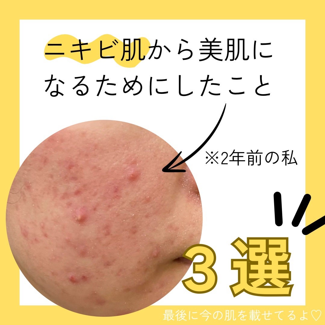 shiro on LIPS 「【ニキビ体質だった私がやったこと】15年以上ニキビと共に歩んで..」(1枚目)
