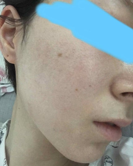 むぎむぎ on LIPS 「肌断食経過記録②10日目最近は日焼け止めとベビーパウダーのみの..」(2枚目)