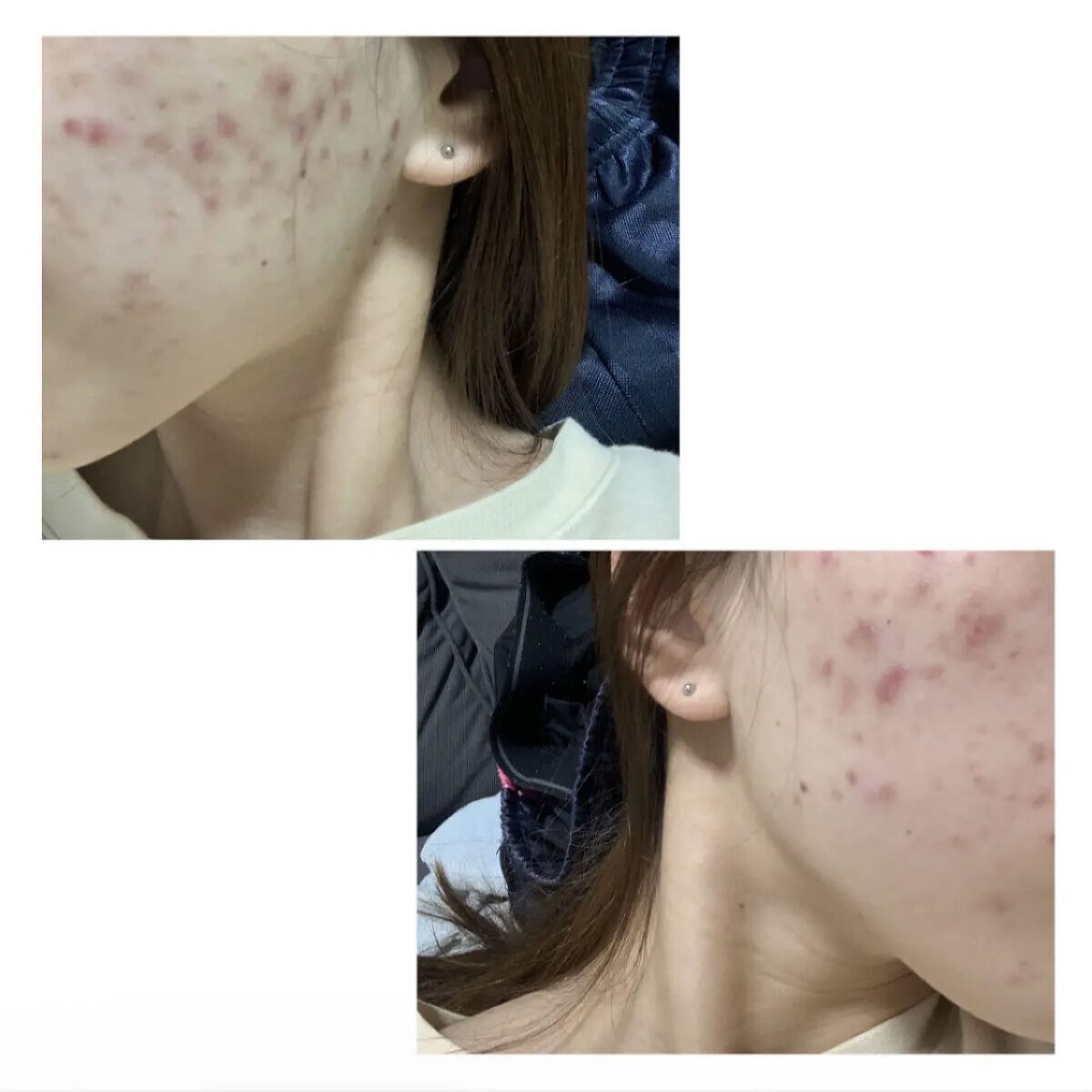 リアルカロテンブレミッシュクリアセラム/APRILSKIN/美容液を使ったクチコミ（2枚目）