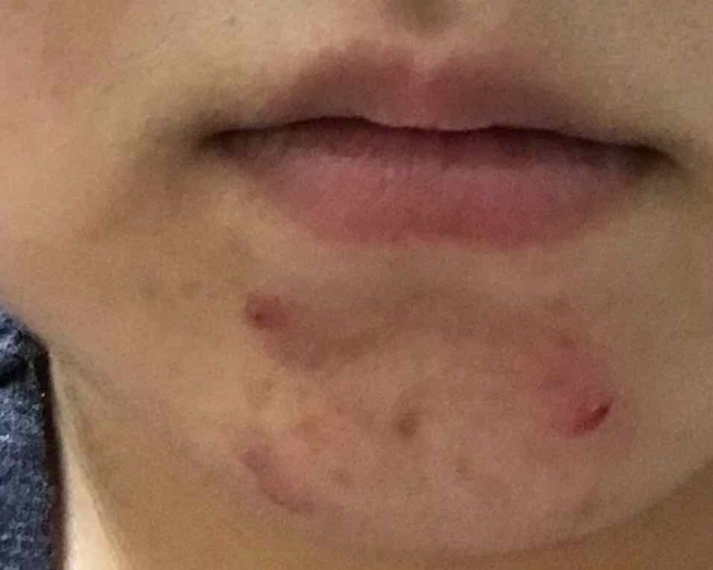 バイオイル/バイオイル/フェイスオイルを使ったクチコミ(2枚目)