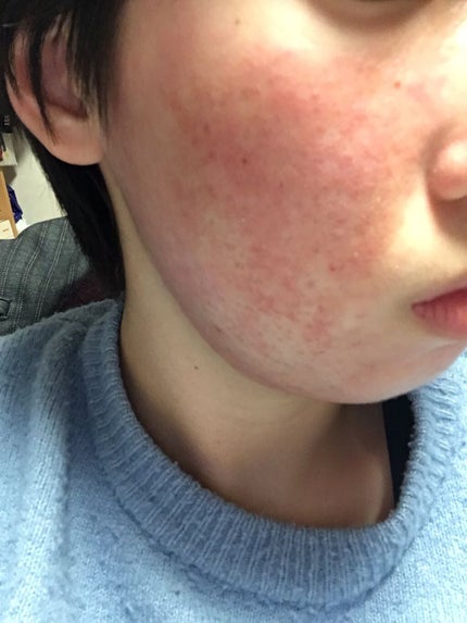 なつみ on LIPS 「今回はペビオゲルについてです。できるだけ手短に行きたいと思いま..」(4枚目)