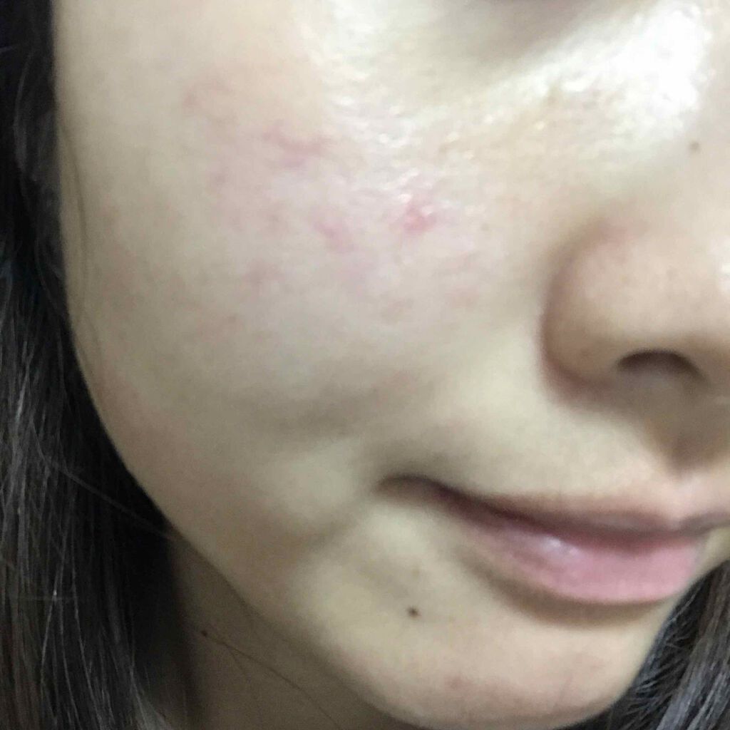 ペアアクネクリームW(医薬品)/ペア/その他を使ったクチコミ（1枚目）