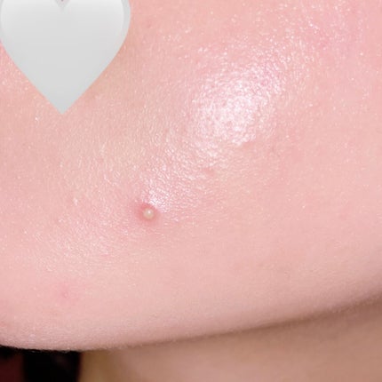 30デイズミラクルクリアスポットパッチ/SOME BY MI/にきびパッチを使ったクチコミ(1枚目)