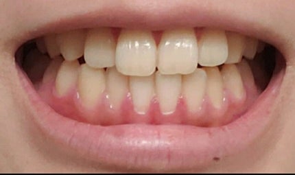 アパガードプレミオ/アパガード/歯磨き粉を使ったクチコミ(4枚目)