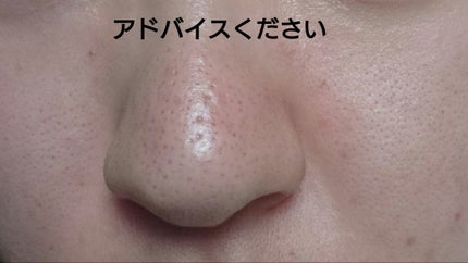 A アクネフォーム/NOV/洗顔フォームを使ったクチコミ(4枚目)