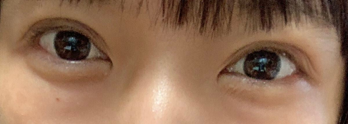 コトリ☆れいか(´∀`)プチプラ on LIPS 「ダウンタイム三日目!腫れもなくメイク可能!埋没3点どめ1980..」(1枚目)