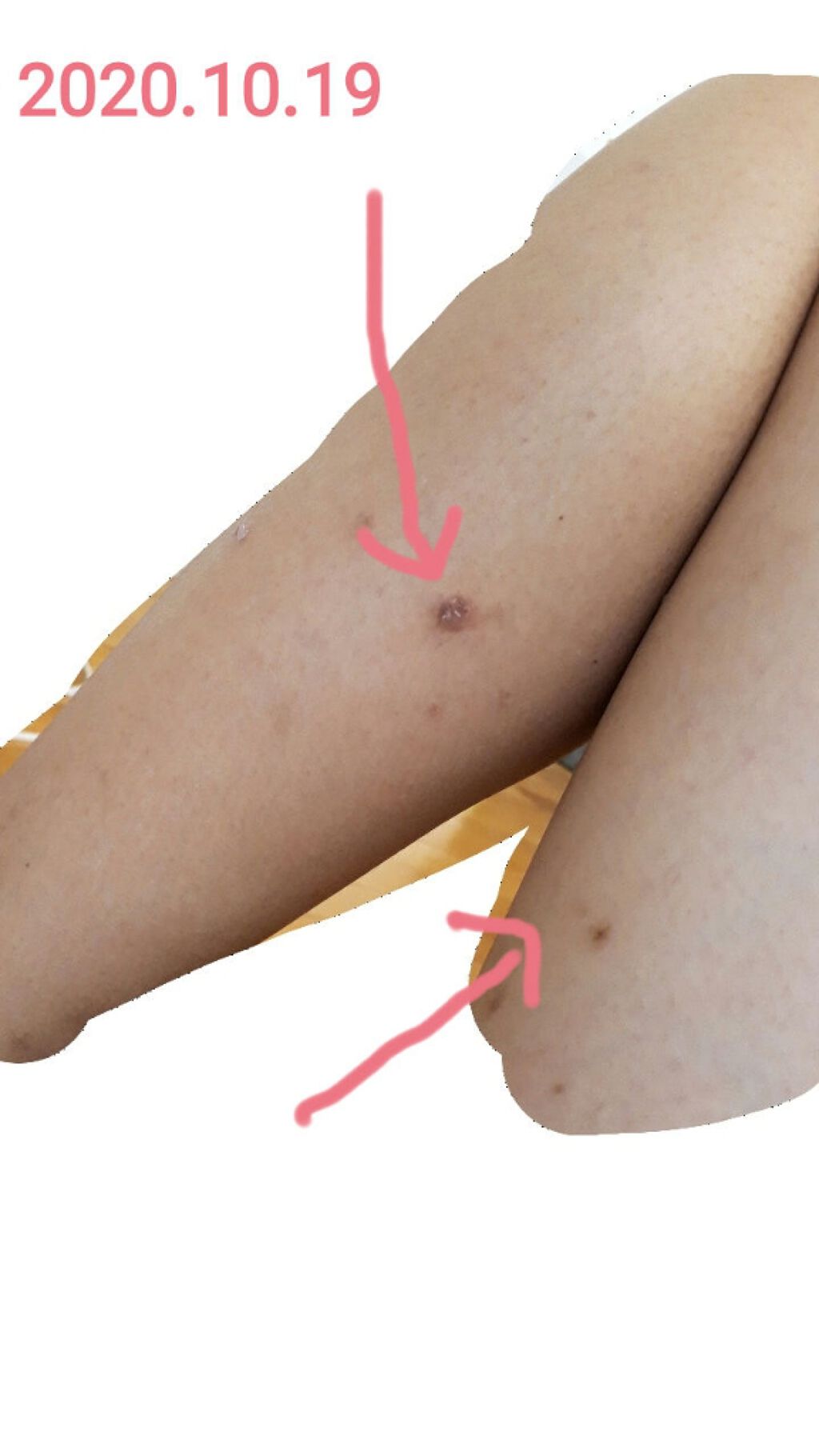 アットノンEX ジェル(医薬品)/アットノン/その他を使ったクチコミ（2枚目）