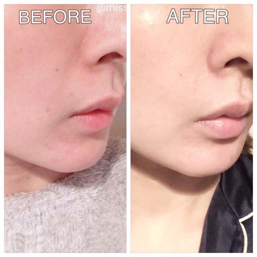 ヒアルロン酸注入/プラウドクリニック/その他を使ったクチコミ(2枚目)