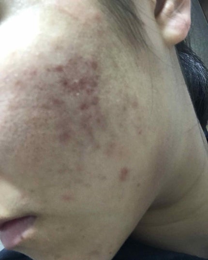 薬用 しみ 集中対策 美容液/メラノCC/美容液を使ったクチコミ(2枚目)