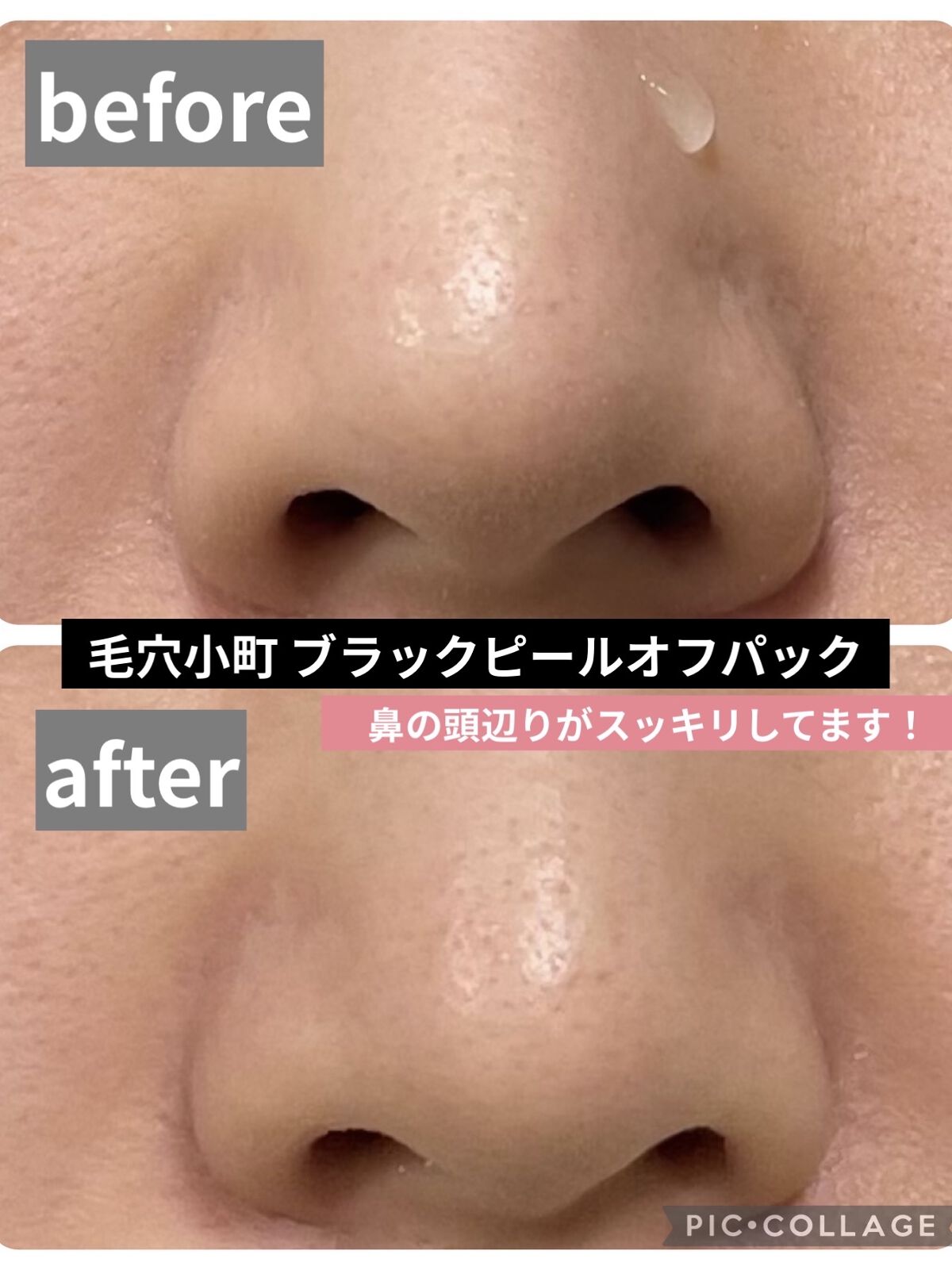 毛穴小町 イエローピールオフパック/クリアターン/ピーリングを使ったクチコミ（2枚目）