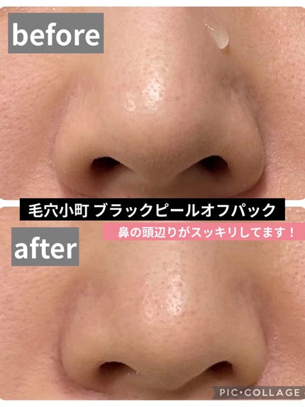 毛穴小町 ブラックピールオフパック/クリアターン/ピーリングを使ったクチコミ(2枚目)