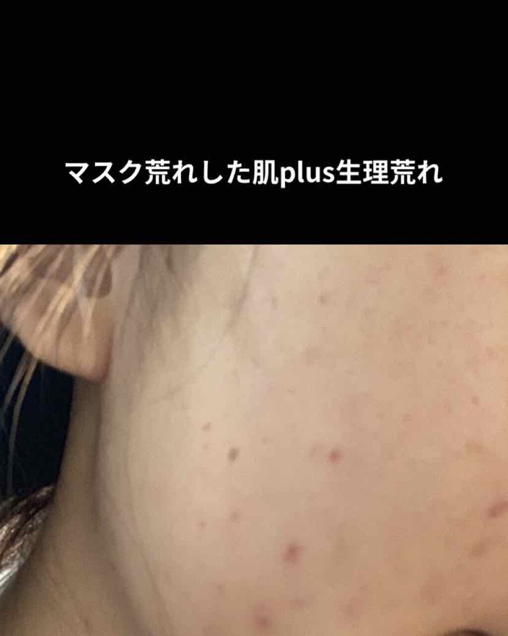 ロゼット洗顔パスタ アクネクリア/ロゼット/洗顔フォームを使ったクチコミ(2枚目)