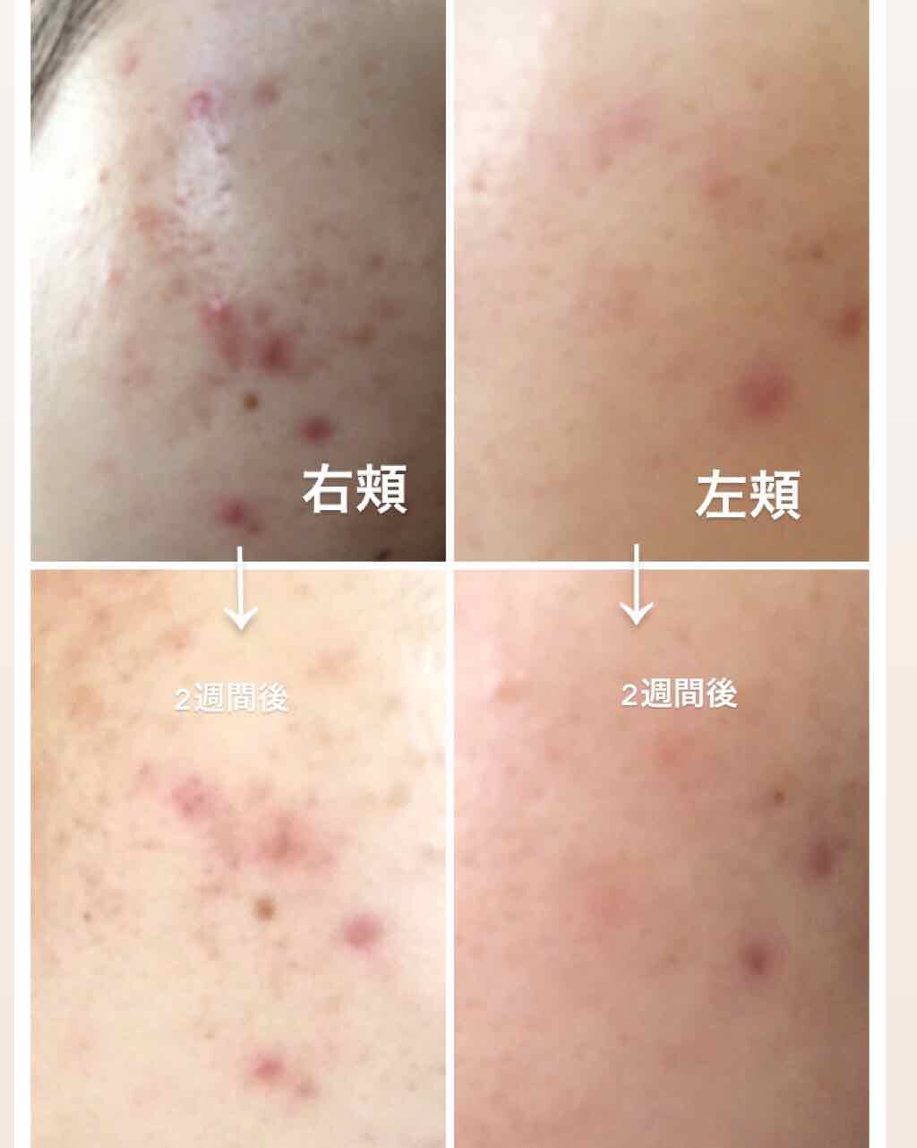 彩花 on LIPS 「⚠️2枚目汚肌写真です⚠️撮り方、日光の入り方によって肌の色バ..」(2枚目)