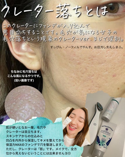 おゆみ|ニキビ・ニキビ跡ケア on LIPS 「【ニキビ跡にクレーターを入れてくれ】クレーターは治らない、と言..」(7枚目)