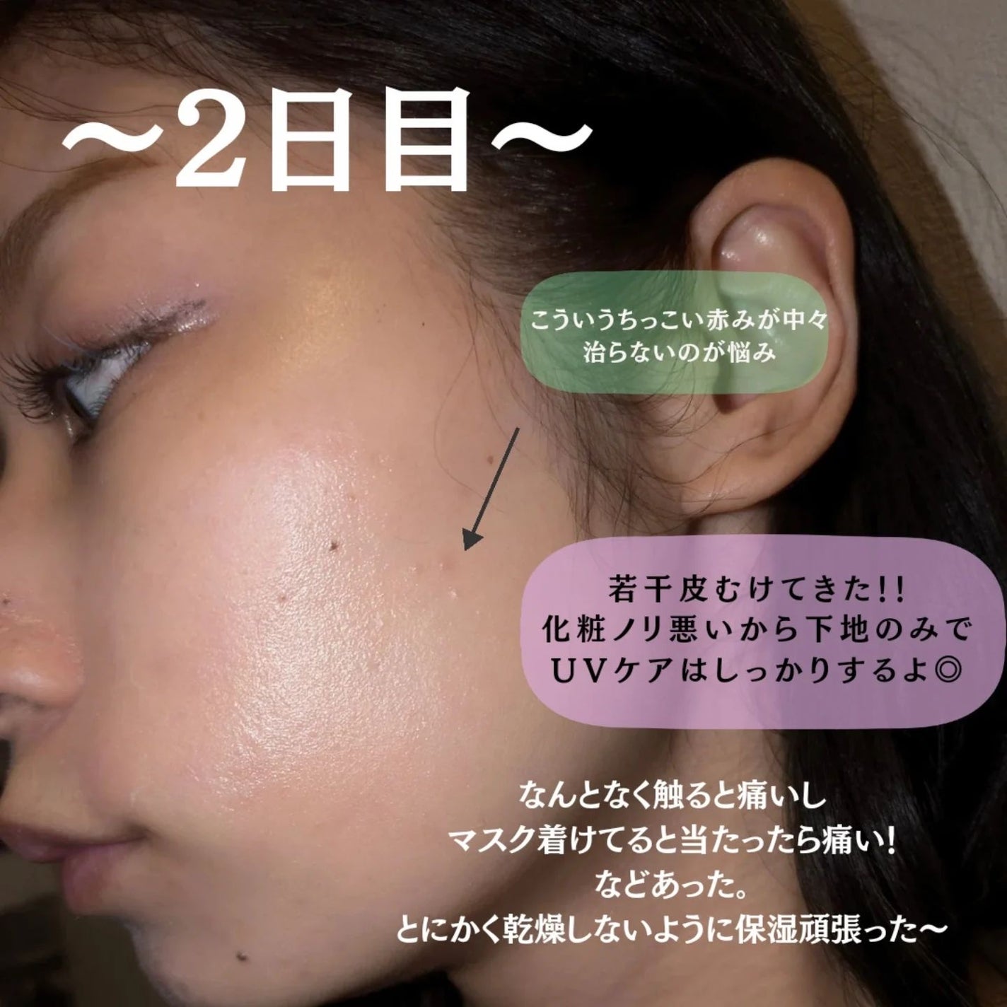 ダーマスキンピーリング/BQCELL/その他キットセットを使ったクチコミ(6枚目)