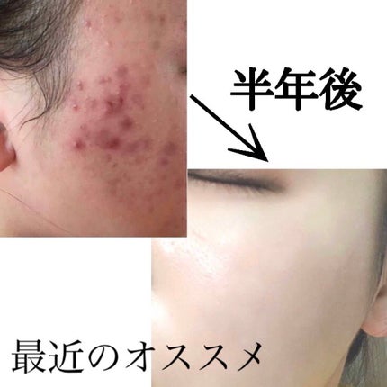 ニキビ治療薬(医薬品)/メンソレータム アクネス/その他を使ったクチコミ(1枚目)