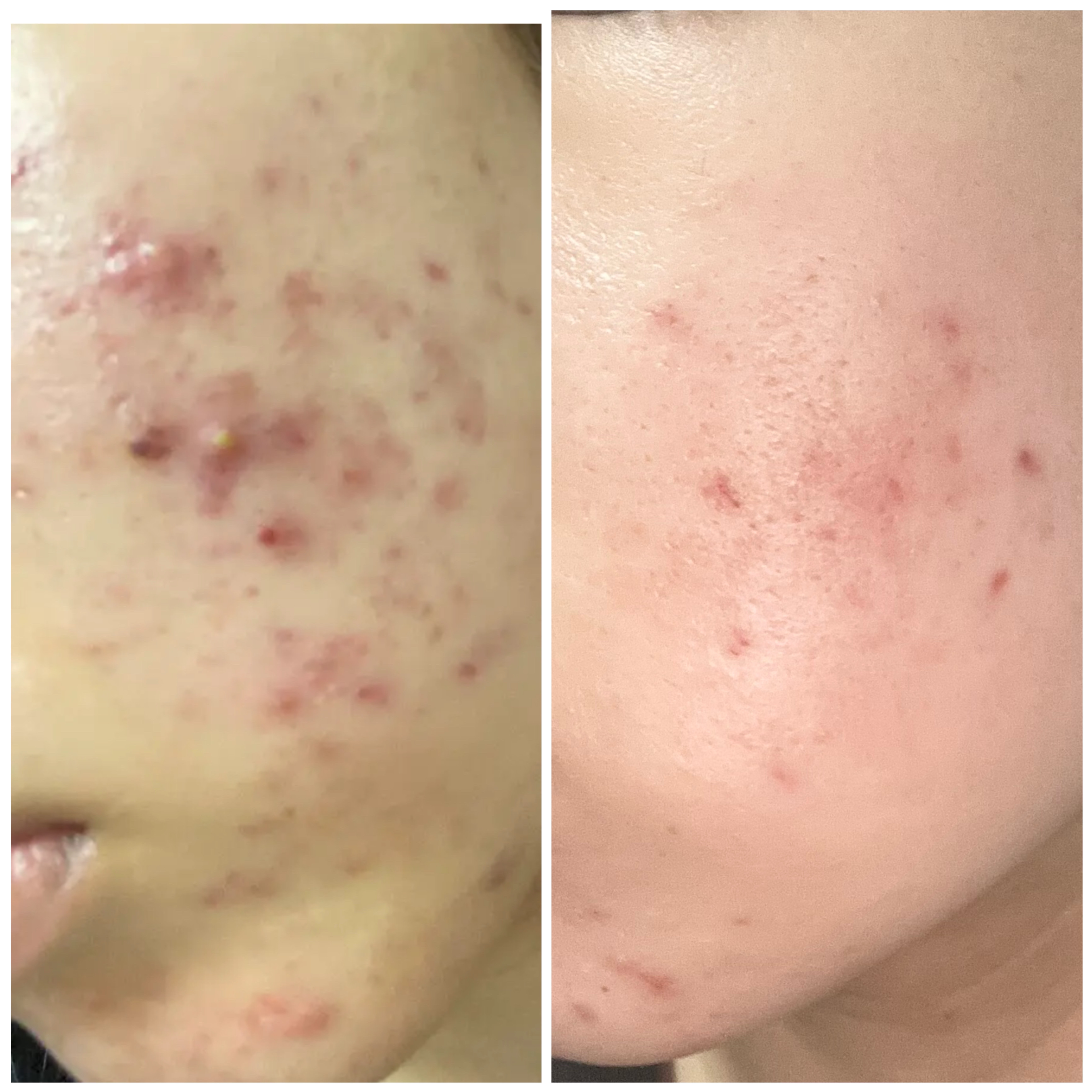 薬用ローション（とてもしっとり）/IHADA/化粧水を使ったクチコミ（2枚目）