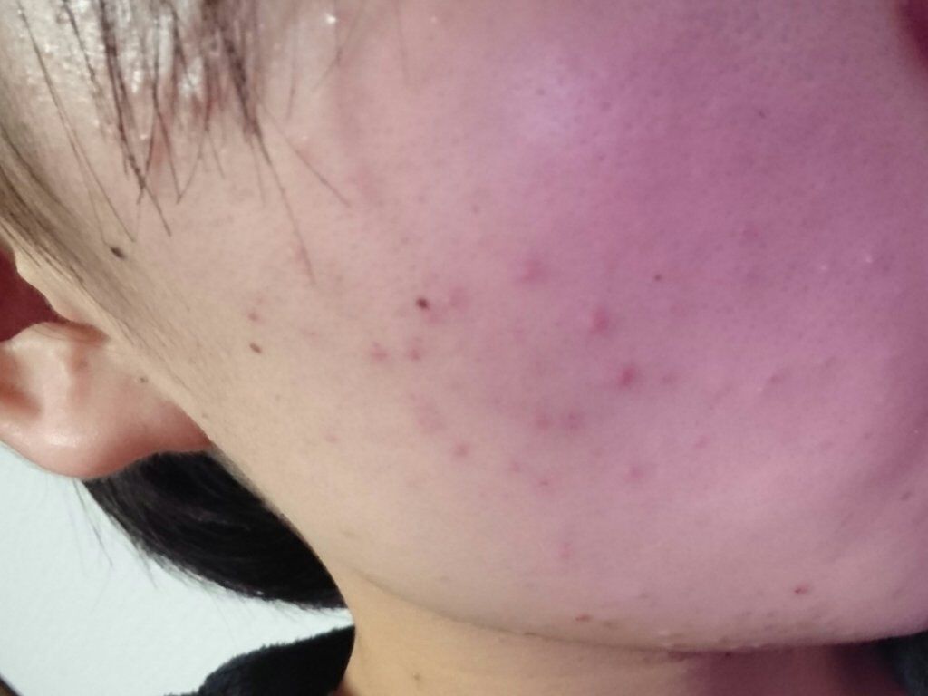 楽天カードマン on LIPS 「昨日より酷くなった気がしてきた😭…..」(2枚目)