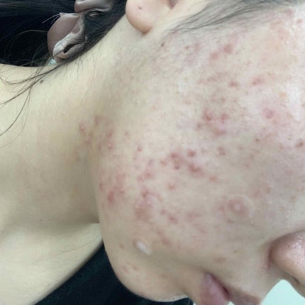 みみみちゃん on LIPS 「閲覧注意です。本当に助けてください。ニキビが治りません。ニキビ..」(2枚目)