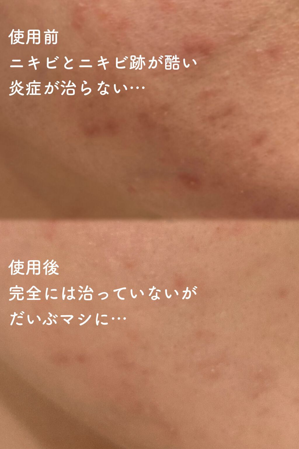 薬用しみ集中対策 プレミアム美容液/メラノCC/美容液を使ったクチコミ(5枚目)