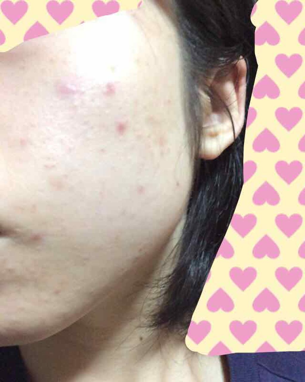 薬用 しみ 集中対策 美容液/メラノCC/美容液を使ったクチコミ（3枚目）