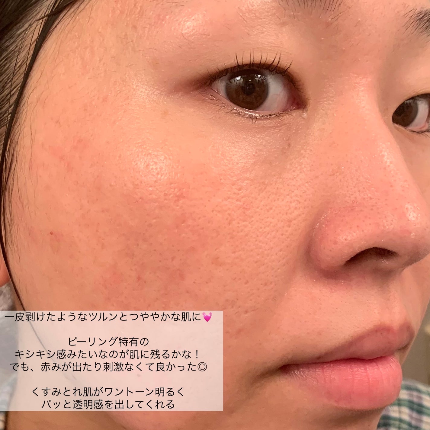 美白乃美人ピーリングジェル/ブレーンコスモス/ピーリングを使ったクチコミ(6枚目)