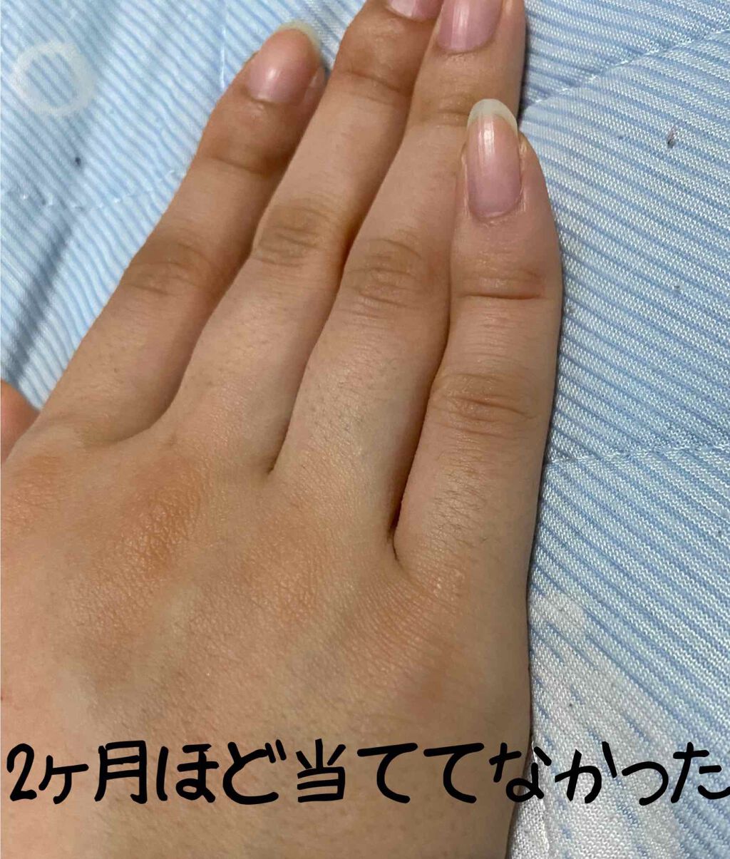 光脱毛器 VIO/Sarlisi/家庭用脱毛器を使ったクチコミ(1枚目)