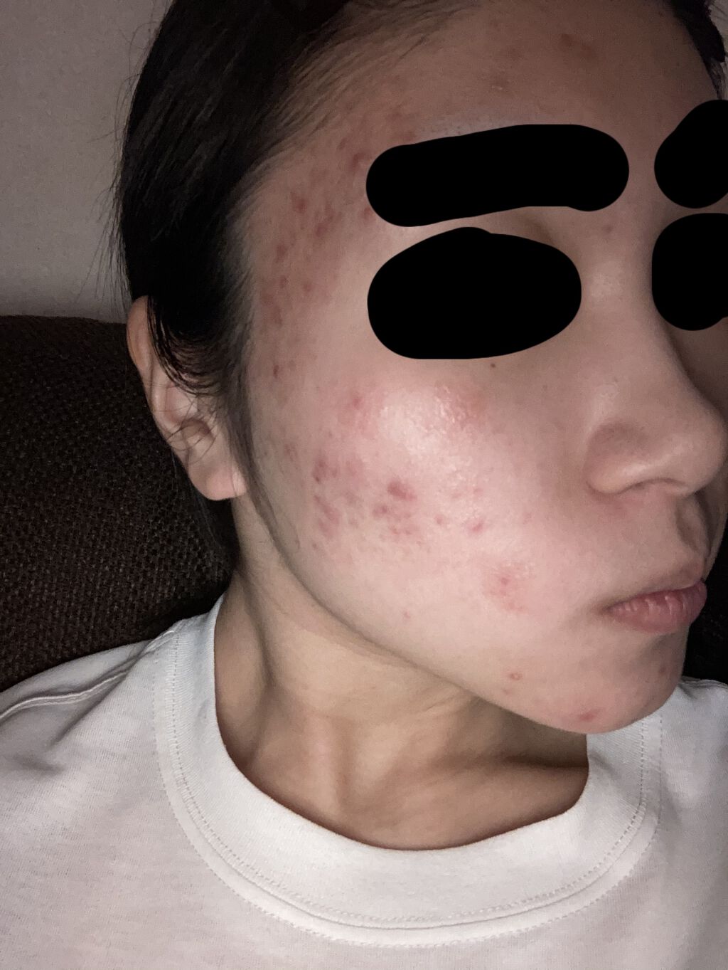 ベピオゲル/マルホ株式会社/その他を使ったクチコミ（1枚目）