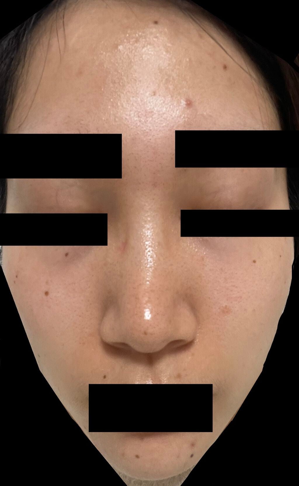 ブスならせめて美肌になりたい on LIPS 「久しぶりの肌。毛穴が少し広がってる??かなあとは顎と額のニキビ..」(1枚目)