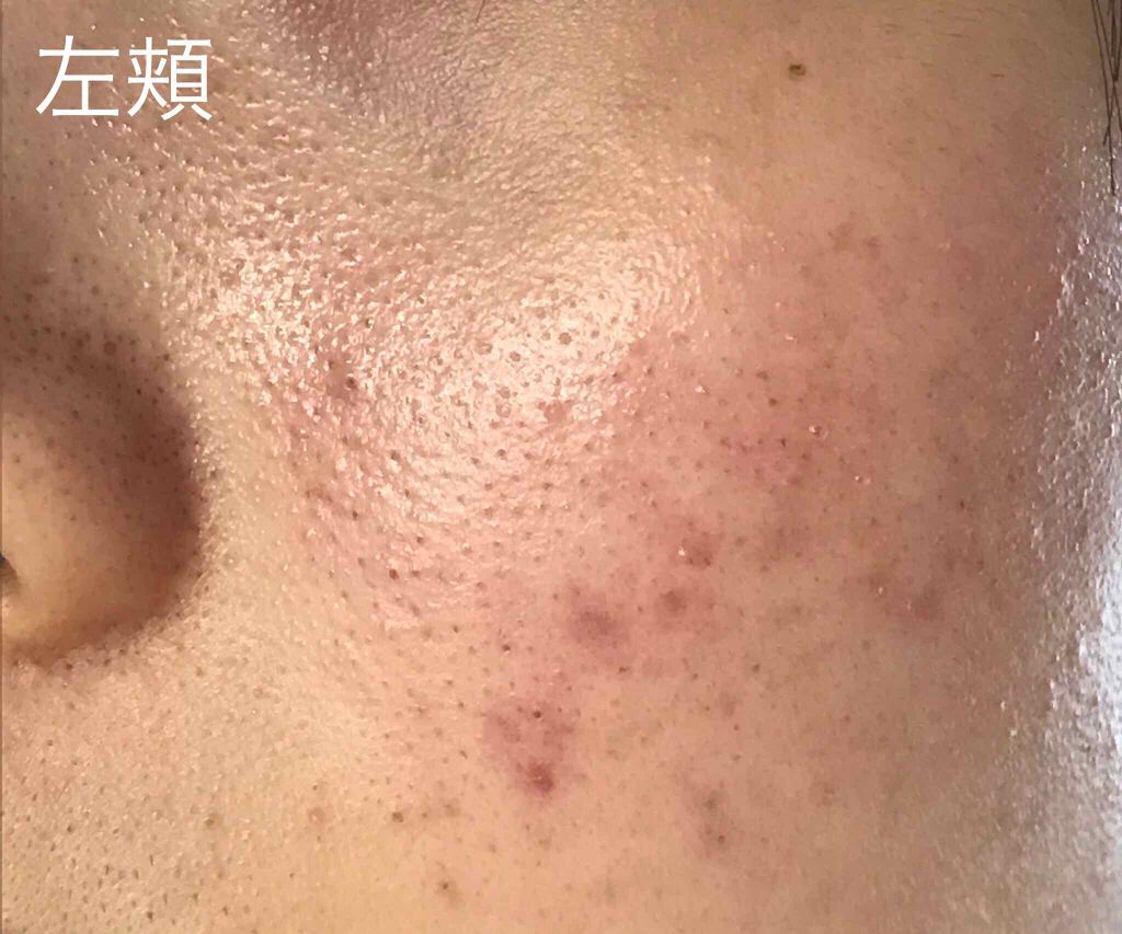 ペアアクネクリームW(医薬品)/ペア/その他を使ったクチコミ(3枚目)